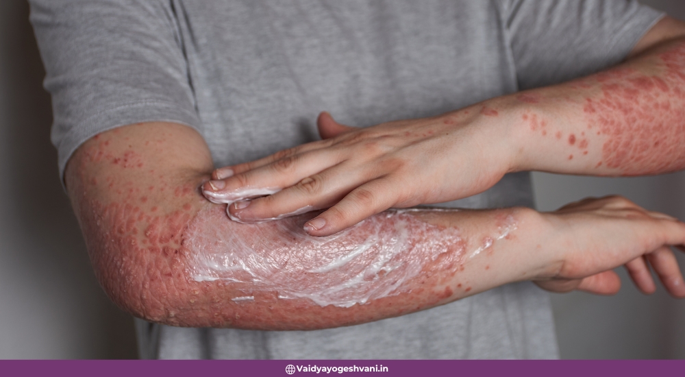 Ayurvedic Treatments for Psoriasis
