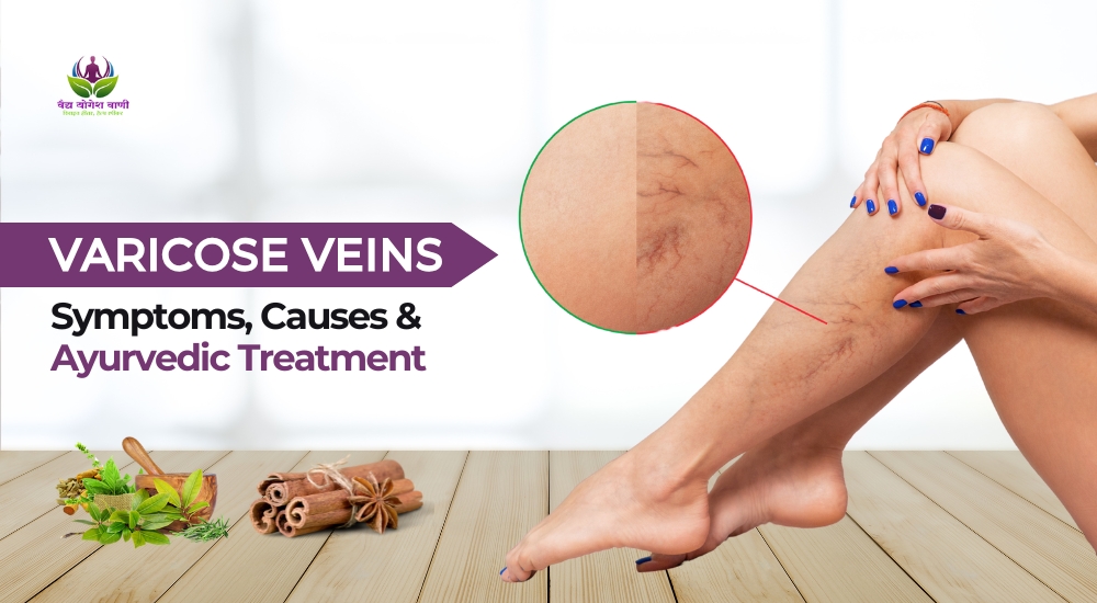 Varicose Veins: Symptoms, Causes & Ayurvedic Treatment
