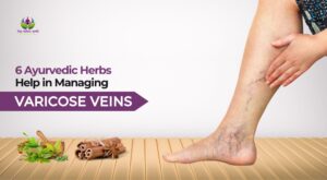 6 Ayurvedic Herbs Help in Managing Varicose Veins