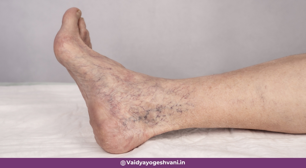 Ayurvedic Herbs for Varicose Veins Treatment
