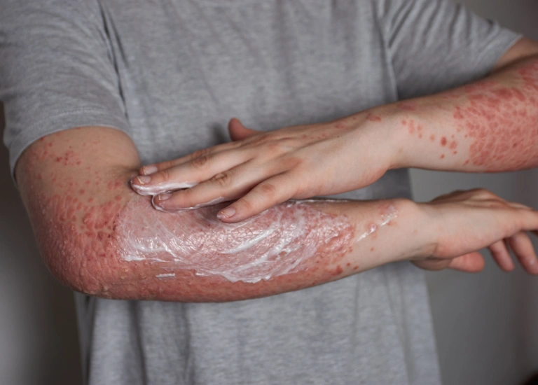 Trusted Fungal Infection Doctor in Surat