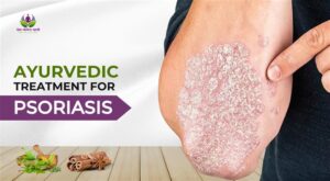Ayurvedic Treatment for Psoriasis: Remedies, Diet & Therapies