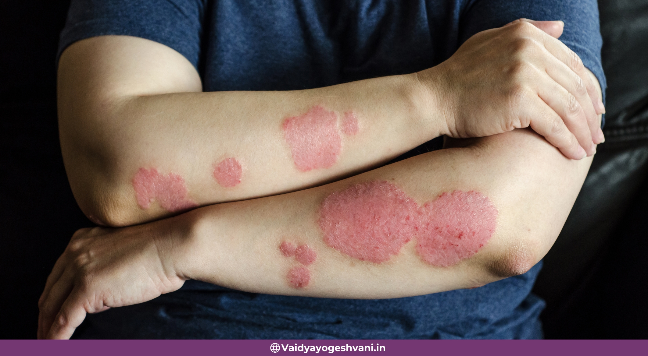Ayurvedic Therapies for Psoriasis
