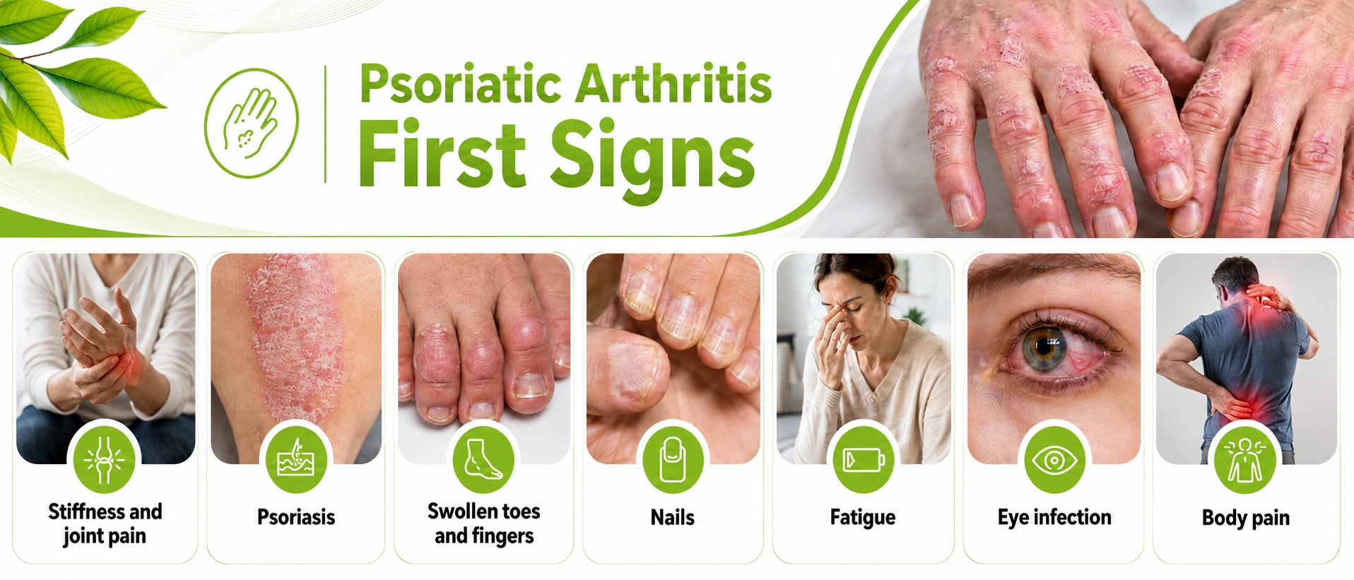 Early Symptoms of Psoriatic Arthritis