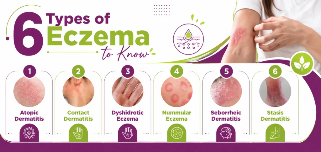 6 Common Types of Eczema You Should Know About