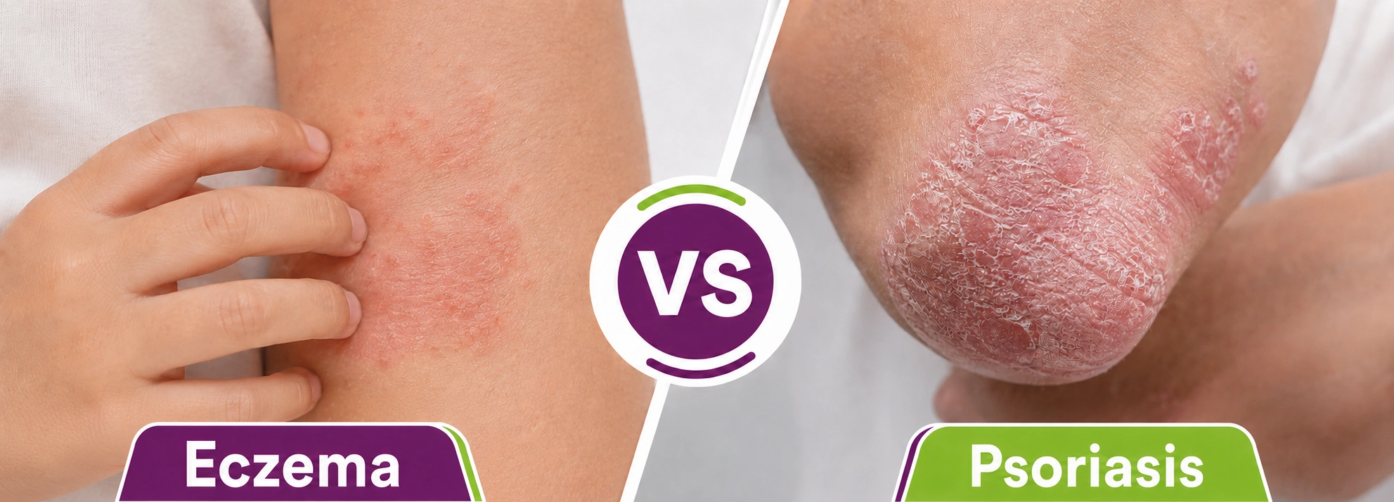 Eczema vs Psoriasis: Key Differences