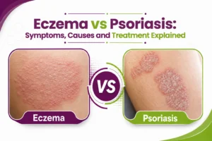 Eczema vs Psoriasis