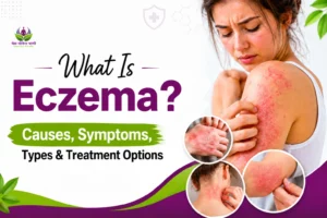 What Is Eczema? Causes, Symptoms, Types & Treatment Options