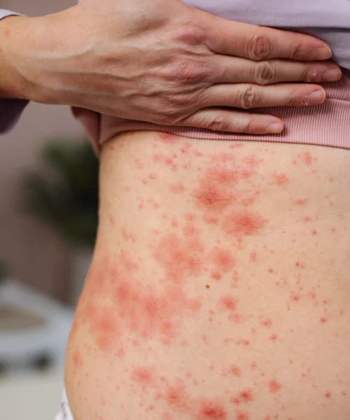 Common Symptoms of Psoriasis
